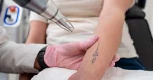 tattoo removal on forearm with laser device in Tracy, CA