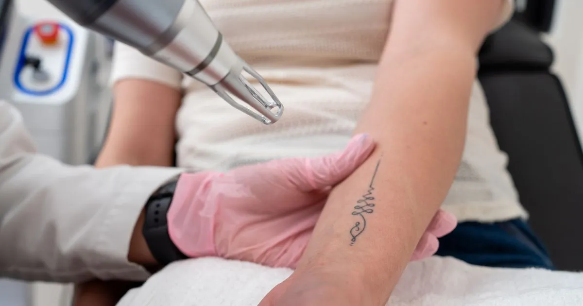 tattoo removal on forearm with laser device in Tracy, CA
