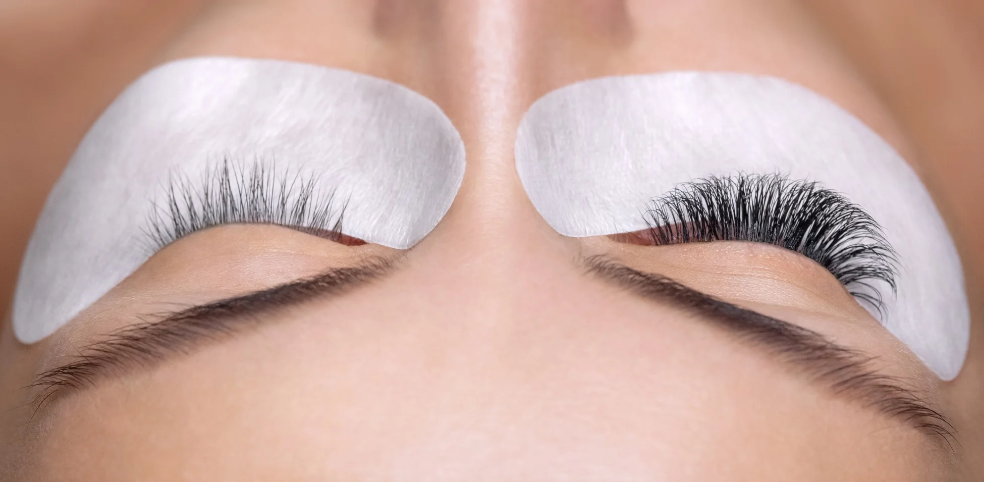 Close-up of eyes with numbing pads applied before aesthetic treatment in Tracy, CA | A Perfect Finnish Medical Spa