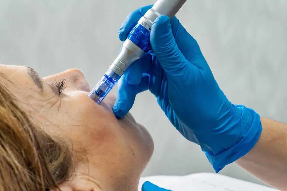 Woman Getting Microneedling Treatment in Tracy, CA | A Perfect Finnish Medical Spa